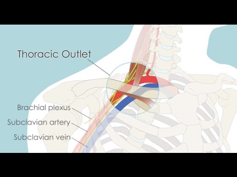 Transaxillary First Rib Resection for Thoracic Outlet Syndrome (TOS)