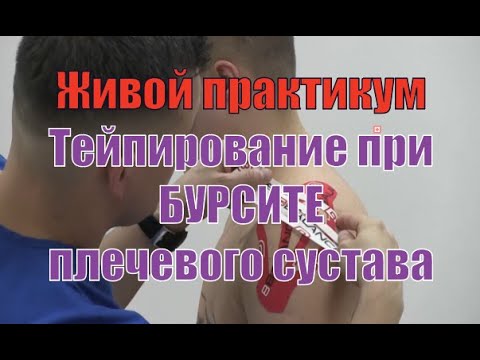 Тейпирование при бурсите плечевого сустава и сопутствующей боли