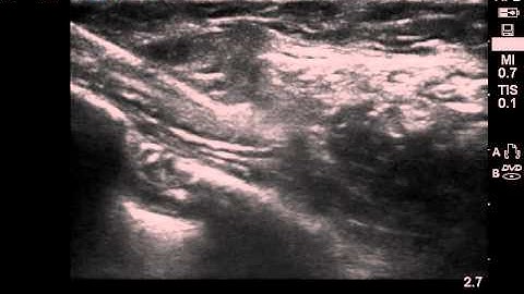 Serratus Plane Block