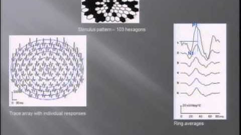 Multifocal Electroretinography and Genetic Correlations in Early Age-Related Macular Degeneration