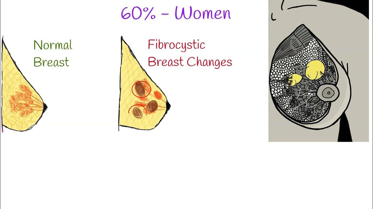 Fibrocystic breast- Causes, Symptoms and Treatment. Fibrocystic Breast  Disease; 