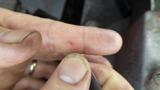 Removing a metal splinter from my finger. contact me at
slaffer21@gmail.com