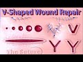 V-Shaped Wound Repair Plus More