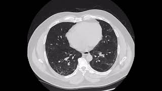 Post Covid 19 Subpleural Lines After 26 Months. Fibrosis Or Slow Resolving Organizing Pneumonia?