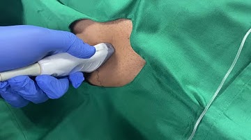 TAP BLOCK IN OBESE PATIENT WITH ULTRASOUND