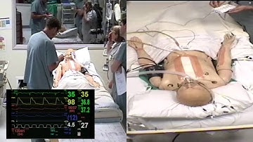 Complete Heart Block Simulation - Epicardial Pacing