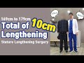 Growing 10cm Taller by Stature Lengthening Surgery