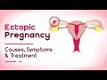 Ectopic Pregnancy - Reasons, Symptoms and Treatment