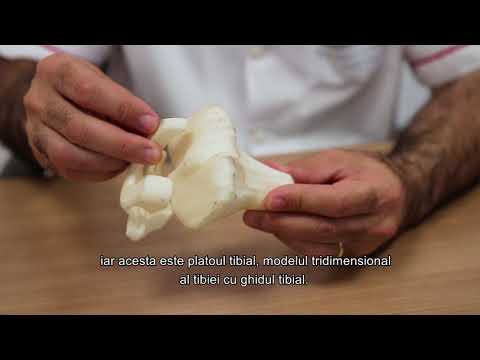 Video: Alternative La Chirurgia De înlocuire A Genunchiului