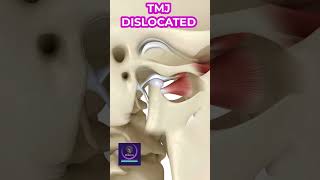 TMJ Dislocation Explained: Causes, Symptoms, and Treatment