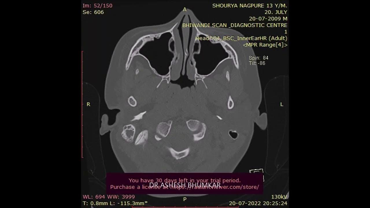 FACIAL NERVE BIFID... Lt. Ear Exploration For Hearing Surgery by Dr