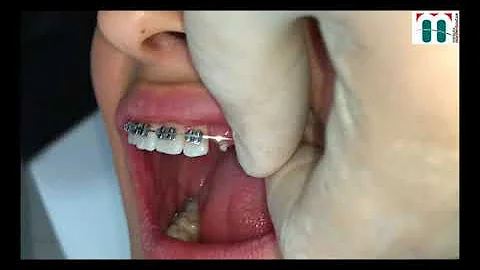 Quanto tempo demora um tracionamento de dente?
