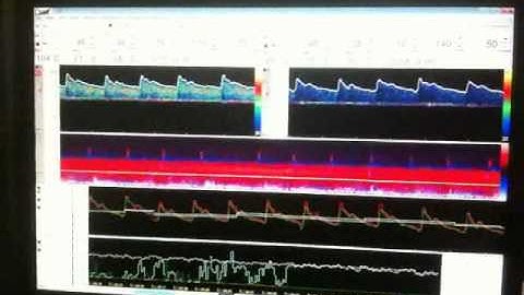 Transcranical doppler integration