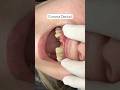 Corona dental #dentista #dentist #dentalprosthesis #crown #dentistry #protesisdental #implantedental