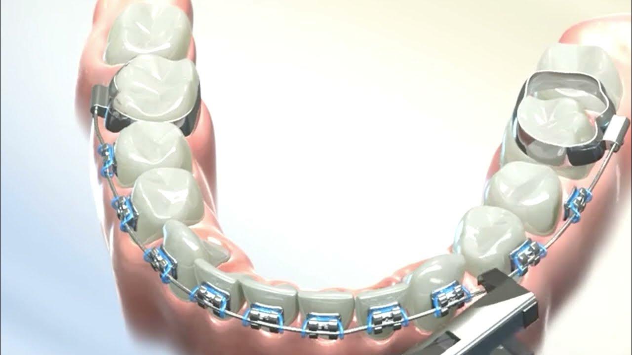 Removing Dental Braces !! Debonding in Orthodontics YouTube