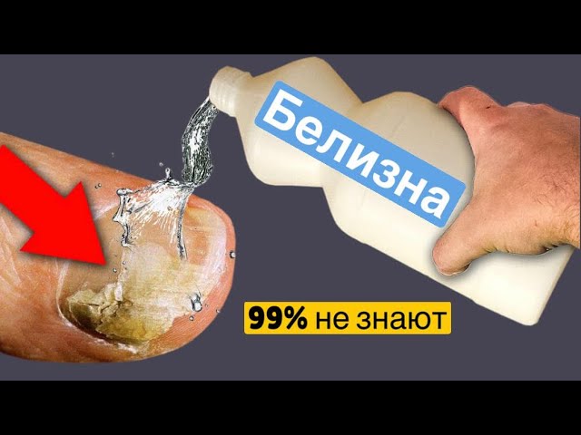Как я уничтожил ГРИБОК НОГТЯ Обычной БЕЛИЗНОЙ! Грибок боится этого больше всего