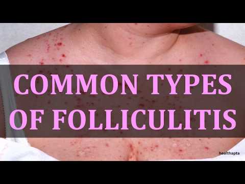 COMMON TYPES OF FOLLICULITIS