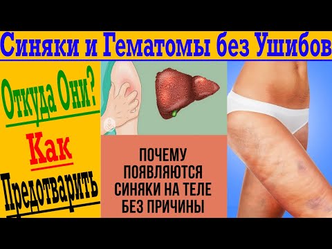 Синяки и гематомы Без ударов и ушибов! Откуда они и как предотвратить?!