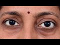 Transconjunctival orbitotomy tips and tricks dr santosh g honavar