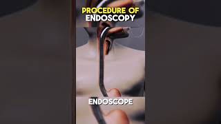 Endoscopy Procedure Endoscopy Procedure