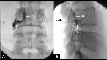 Fluoroscopic guided Lumbar epidural injection ( Right L4 nerve root)