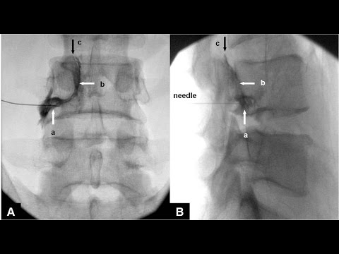 Fluoroscopic guided Lumbar epidural injection ( Right L4 nerve root)