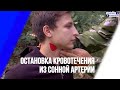 Остановка кровотечения из сонной артерии прижатием. Способ №1