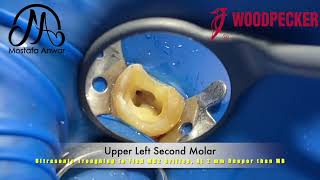 Ultrasonic Troughing using Woodpecker D600 to Find MB2 in Upper Molar & Access Cavity Refinement