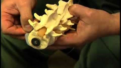 Spinal Cord Stimulator for Chronic Pain