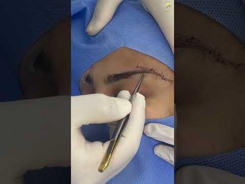   شد الحاجب بطقنية الماكس فاكس مع جراح تجميل و ترميم الوجه و الفكين معن الخطيب 