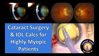 myopia műtétje
