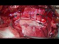 Surgery for Thoracic / Dorsal Meningioma