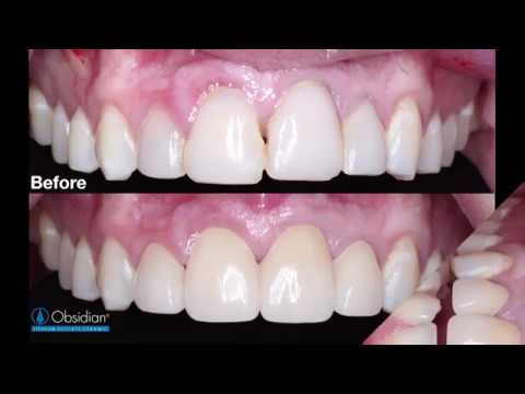 Case of the Week: Replacing Unesthetic Direct Composite Veneers