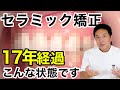 30代でセラミック矯正すると50代ではこうなる!【出っ歯】
