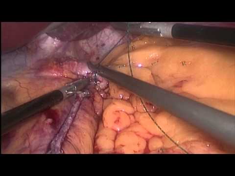 Tüp Mide Ameliyatı (Sleeve Gastrectomy): Unedited  Doç  Dr  Koray Atila & Uzm Dr Serhan Derici