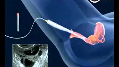 Est-ce que la ponction d'ovocytes fait mal