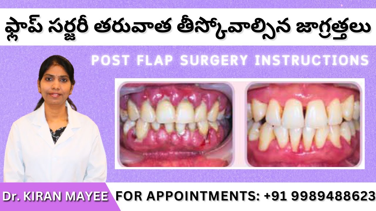 ఫ్లాప్ సర్జరీ తరువాత తీస్కోవాల్సిన జాగ్రత్తలు POST FLAP SURGERY INSTRUCTIONS | by Dr. KIRAN MAYEE