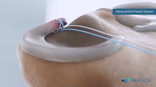 Meniscal Root Repair Using WasherCap™ Mini