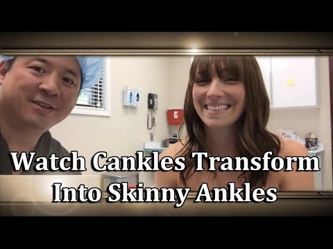 Video: Hur bli av med Cankles (med bilder)