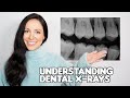 How To Understand Your Dental X-rays (Dental Hygienist Explains)