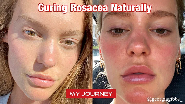 Cure Rosacea Naturally | Georgia Gibbs | My Experi...