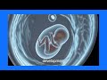 Understanding Subchorionic Cysts: Benign Placental Findings on Ultrasound with Color Doppler