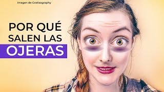 Las causadas ojeras por ¿Cuáles son