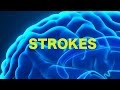 Strokes & The Rule of 4s || USMLE
