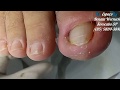 Espiculaectomia bilateral. Cuidado ao cortar as unhas!