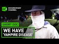 We Have 'Vampire Disease'. What is xeroderma pigmentosum, or XP? | Short Doc