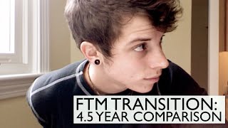 FTM Transition: 4.5 years on Testosterone comparison!