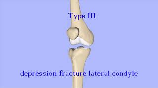 Tibial Plateau Fractures