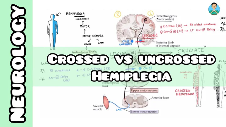 Crossed VS Uncrossed Hemiplegia | Neurology | USMLE, NCLEX