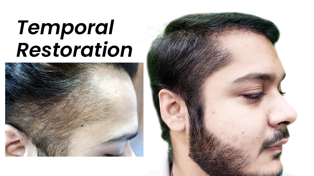 Temple Hair Transplant | Hairline Reconstruction | - YouTube